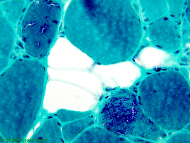 Inclusion body myositis, Gomori trichrome stain x400